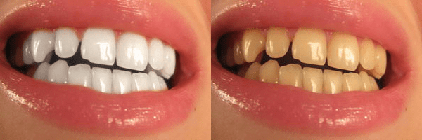 Kak otbelit zubyi v Fotoshope